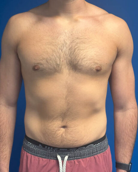 Gynecomastia case #4042