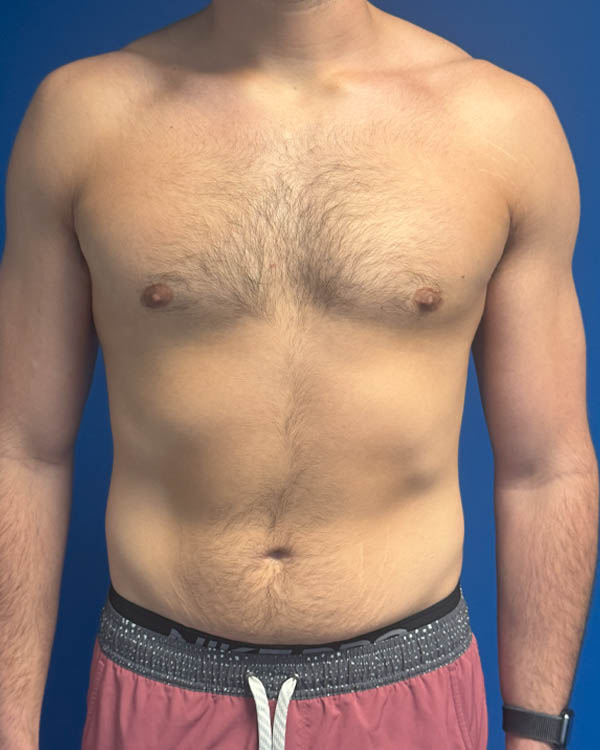 Gynecomastia case #4042