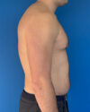 Gynecomastia case #4042