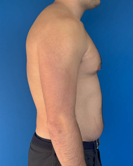 Gynecomastia case #4042