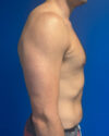 Gynecomastia case #4042
