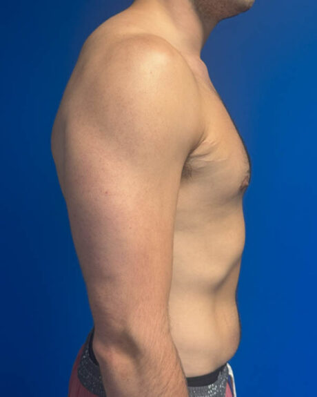 Gynecomastia case #4042
