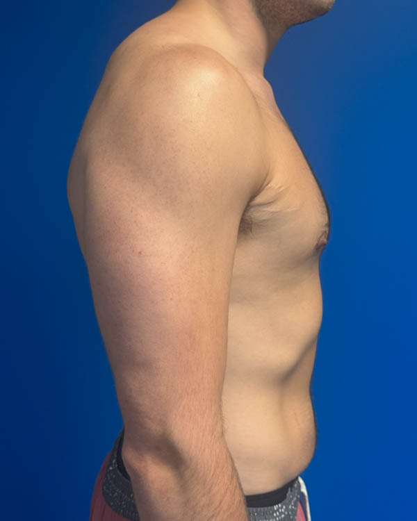 Gynecomastia case #4042