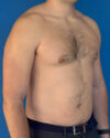 Gynecomastia case #4042