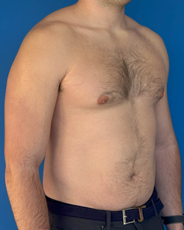 Gynecomastia case #4042