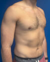 Gynecomastia case #4042