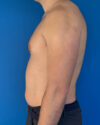 Gynecomastia case #4042