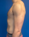 Gynecomastia case #4042