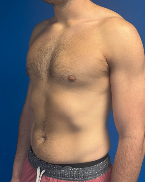Gynecomastia case #4042