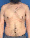 Gynecomastia case #4053