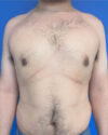 Gynecomastia case #4053