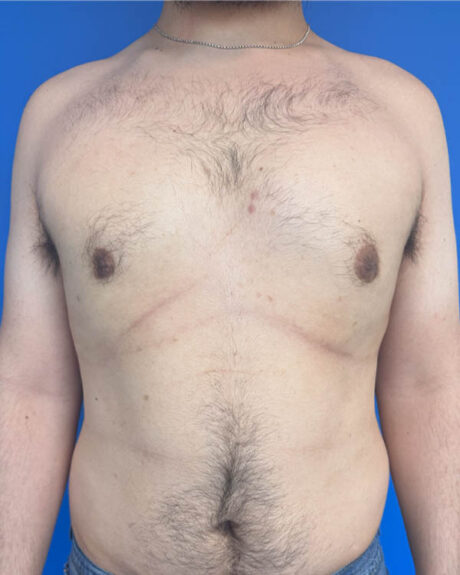 Gynecomastia case #4053