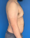 Gynecomastia case #4053