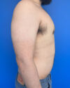 Gynecomastia case #4053