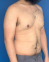 Gynecomastia case #4053
