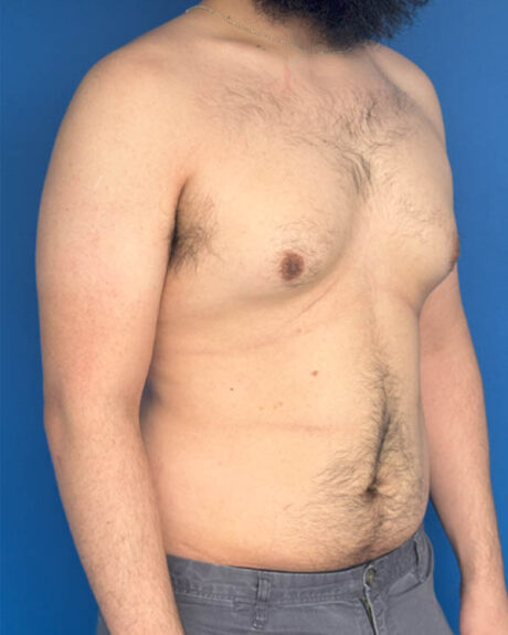 Gynecomastia case #4053