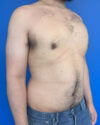Gynecomastia case #4053