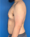 Gynecomastia case #4053