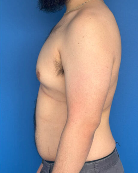 Gynecomastia case #4053