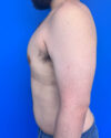 Gynecomastia case #4053