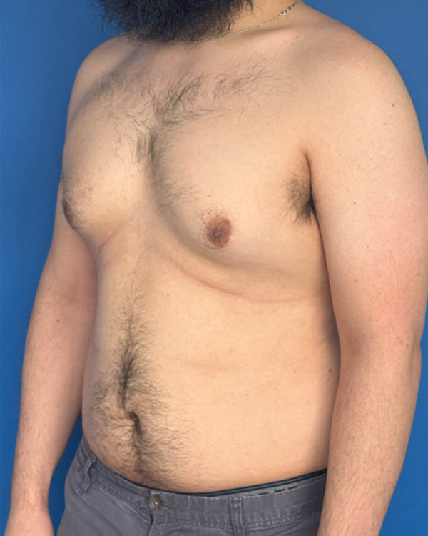 Gynecomastia case #4053