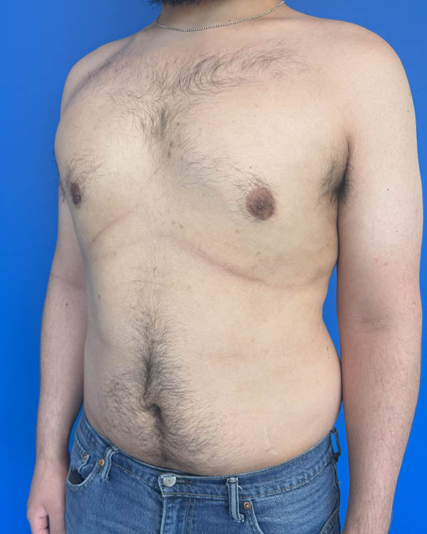 Gynecomastia case #4053