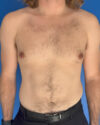 Gynecomastia case #4064