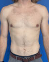 Gynecomastia case #4064