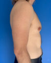 Gynecomastia case #4064