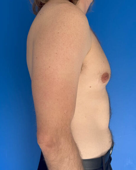 Gynecomastia case #4064