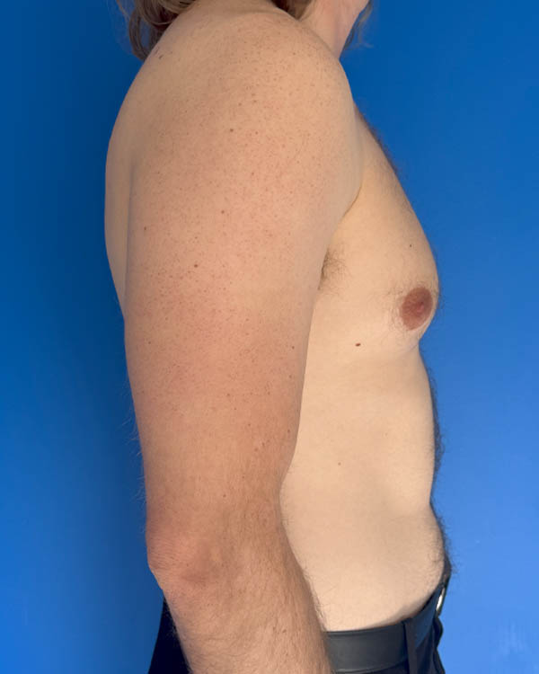 Gynecomastia case #4064