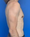 Gynecomastia case #4064