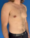 Gynecomastia case #4064
