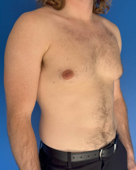 Gynecomastia case #4064