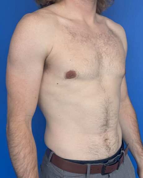 Gynecomastia case #4064
