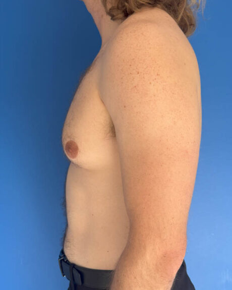 Gynecomastia case #4064