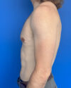 Gynecomastia case #4064