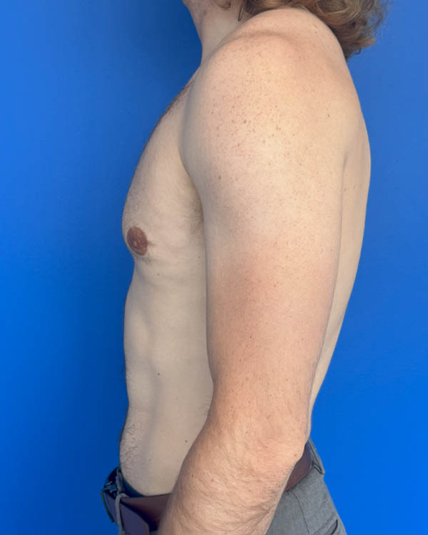 Gynecomastia case #4064