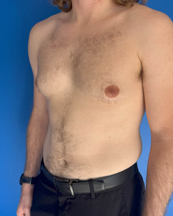 Gynecomastia case #4064
