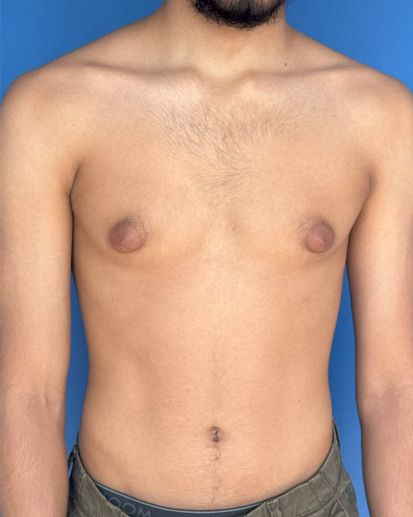 Gynecomastia case #4075