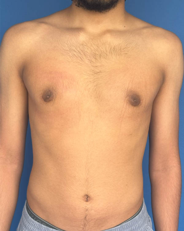 Gynecomastia case #4075