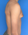 Gynecomastia case #4075
