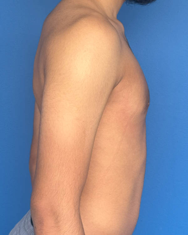 Gynecomastia case #4075