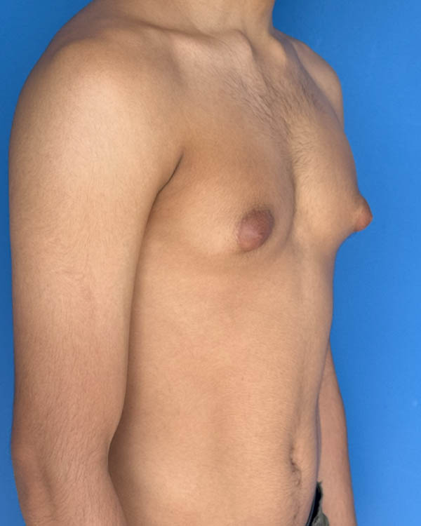 Gynecomastia case #4075