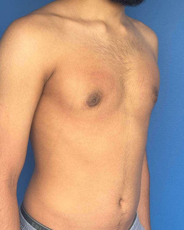 Gynecomastia case #4075