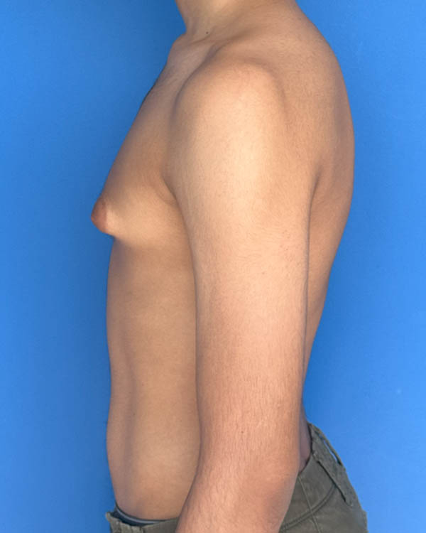 Gynecomastia case #4075