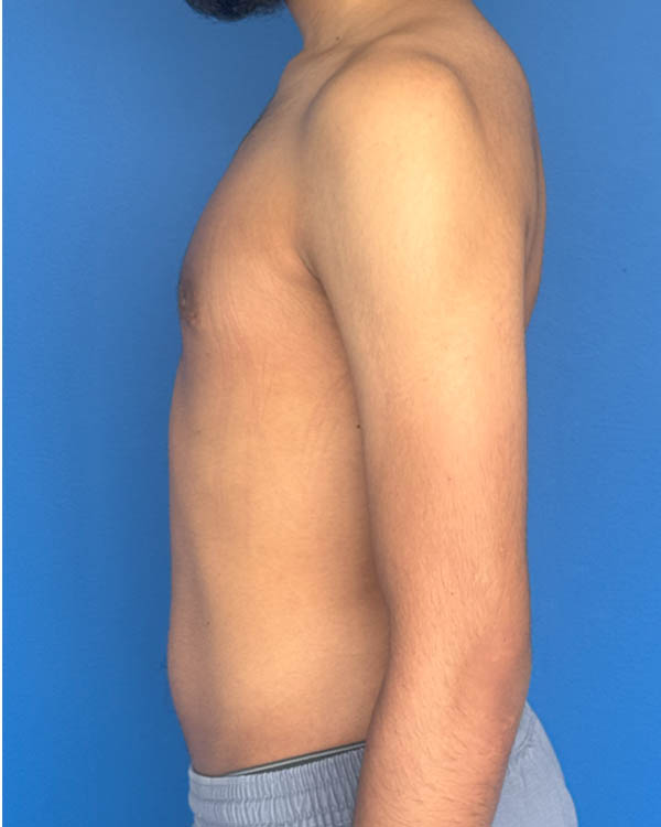 Gynecomastia case #4075