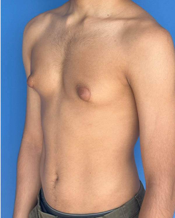 Gynecomastia case #4075