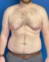 Gynecomastia case #4086