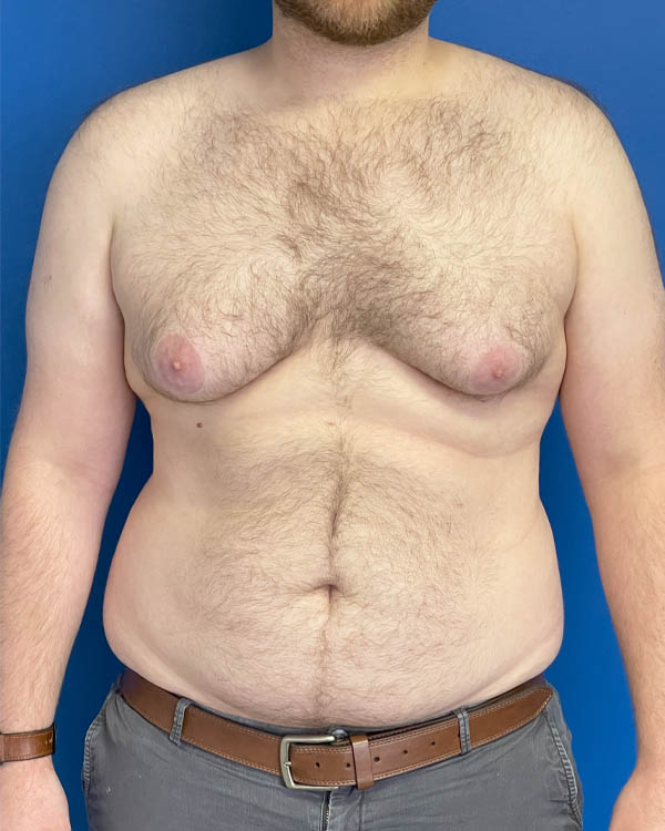 Gynecomastia case #4086